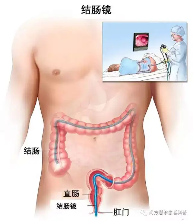 都是大肠癌，结肠癌和直肠癌到底有什么区别？ - 知乎