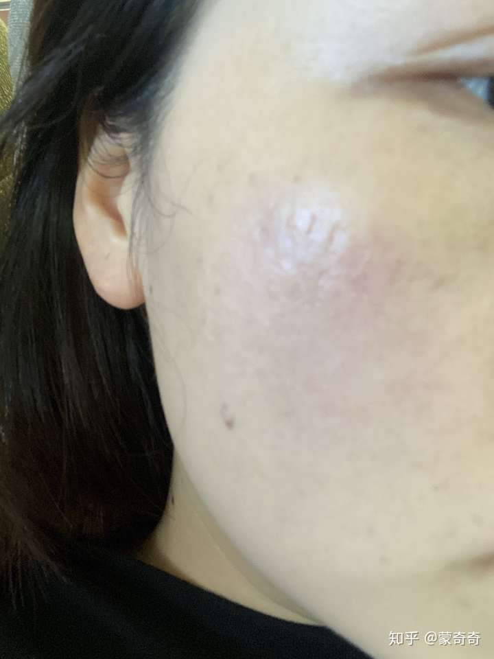 点阵激光去陈旧凹陷疤痕