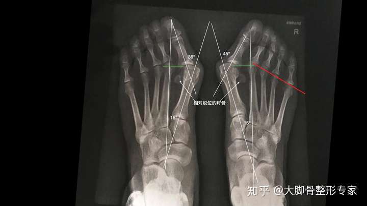 拇外翻角度以及相对移位的籽骨