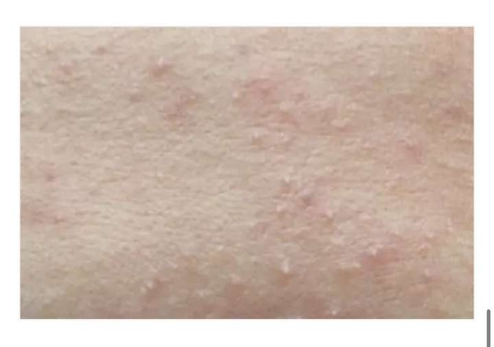 闭口粉刺怎么消除?