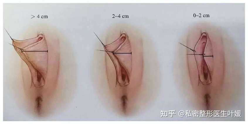 女生因小阴唇肥大 骑车时有刺痛感 该如何改善 知乎