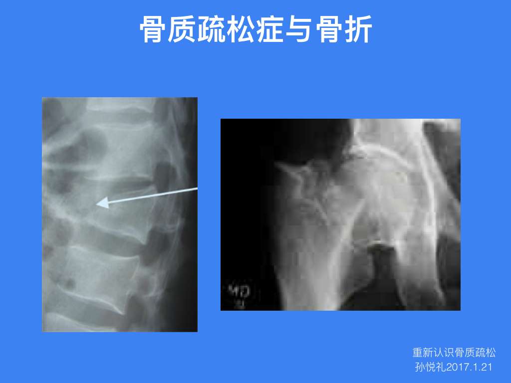 重新认识骨质疏松 一年之后再来说说我们的 贱骨头 知乎