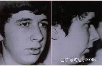 口呼吸与面型发育