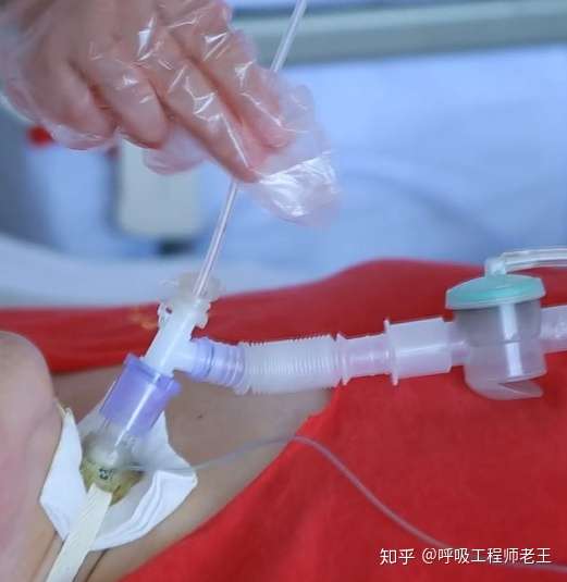 看完这篇文章 气切护理就明白了90 知乎