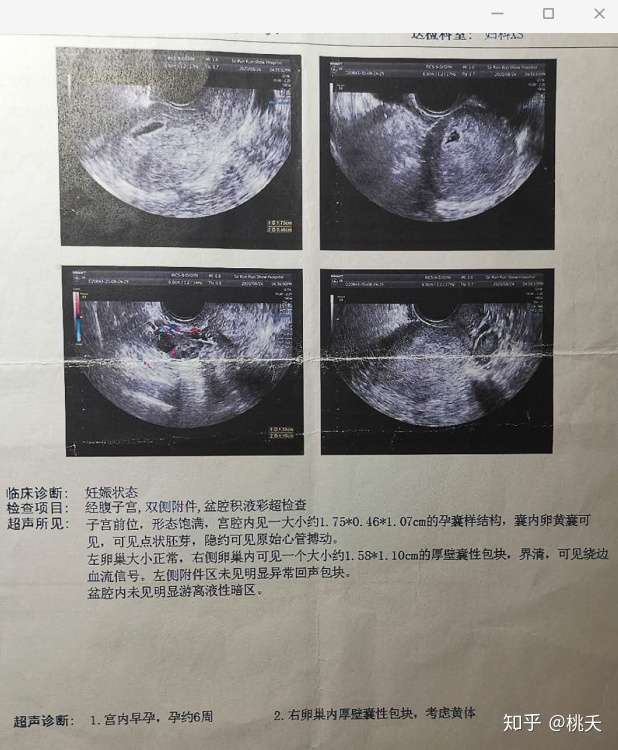 8 24 回忆第一次自然流产过程 知乎 8 24 回忆第一次自然流产过程 知乎