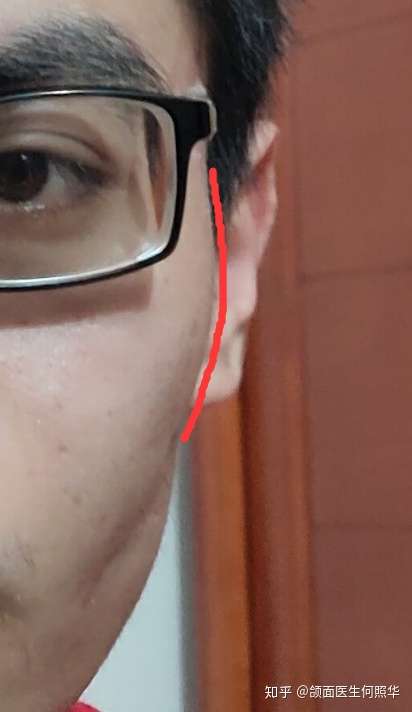 左脸脸颊凹陷可以自己恢复吗