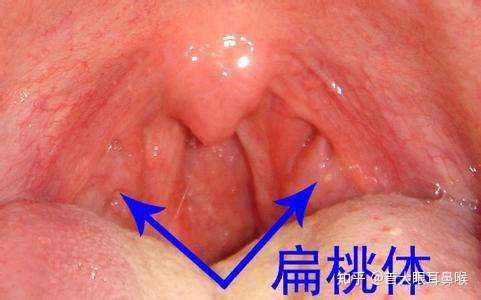 首大石萍 单侧扁桃体肿大不能大意 知乎