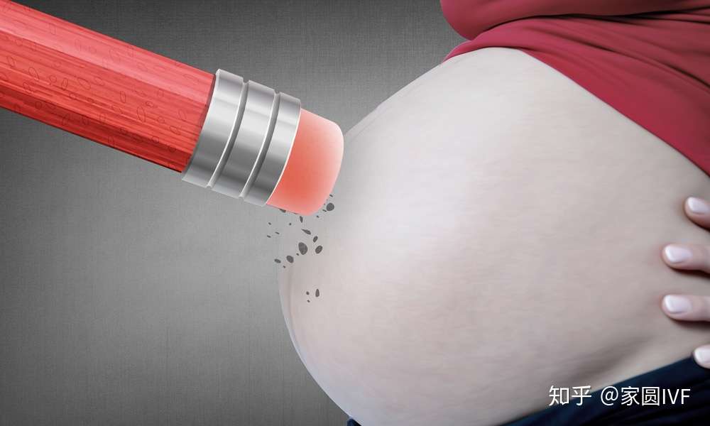 试管婴儿的男女性别比例如何 知乎