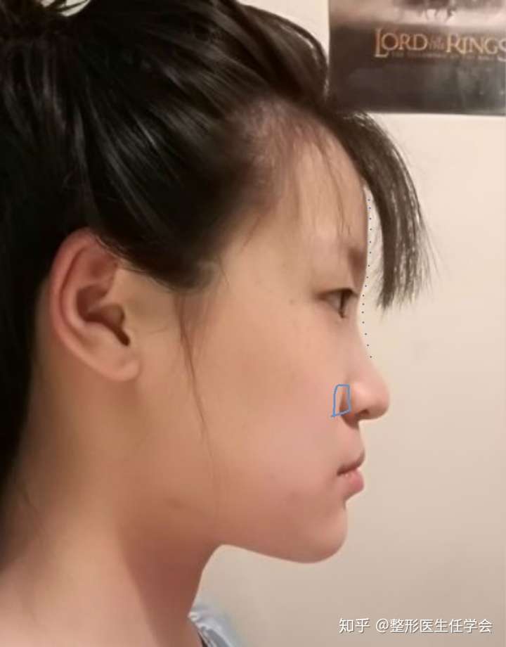 请问这属于下颚前突还是面部凹陷