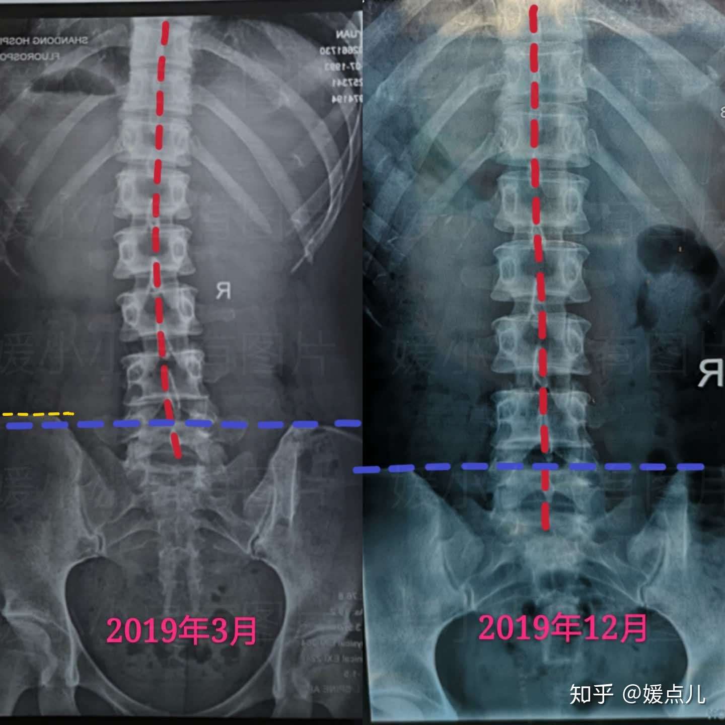 腰椎间盘突出n年后 我已基本战胜了它 康复时间1年 知乎