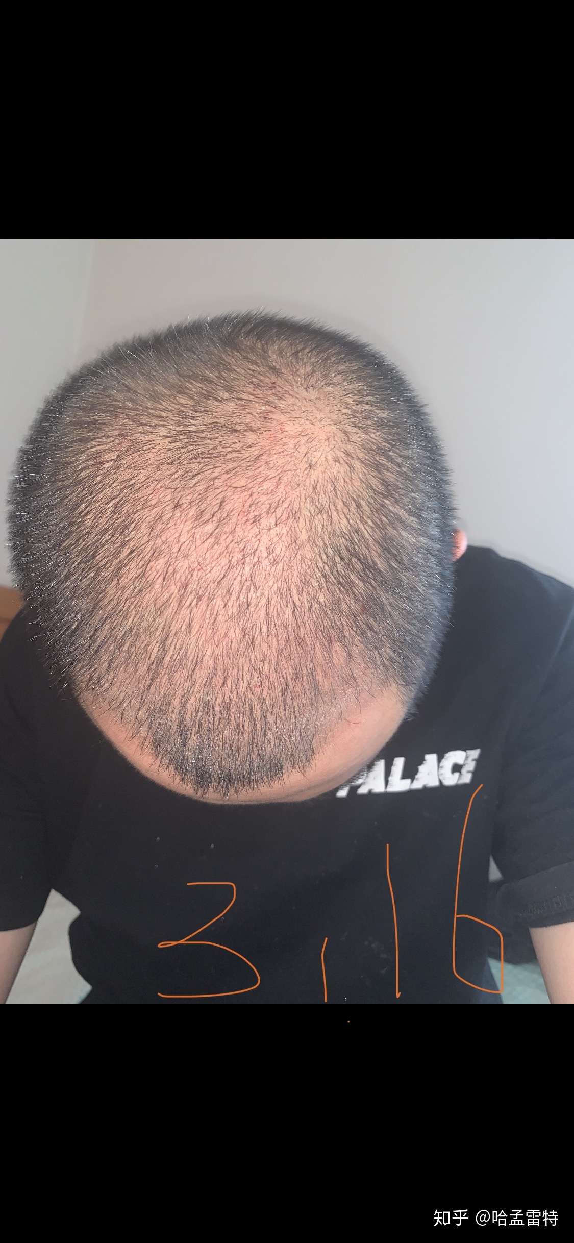 微针生发三个月效果记录贴 持续更新 知乎