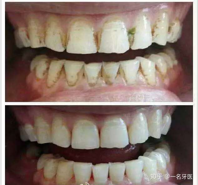 怎么样才可以让牙齿变白