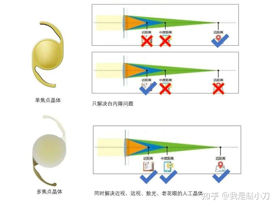 多焦点晶体的缺点 1 医生 你敢不敢把多焦点人工晶体的缺点和盘托出 知乎