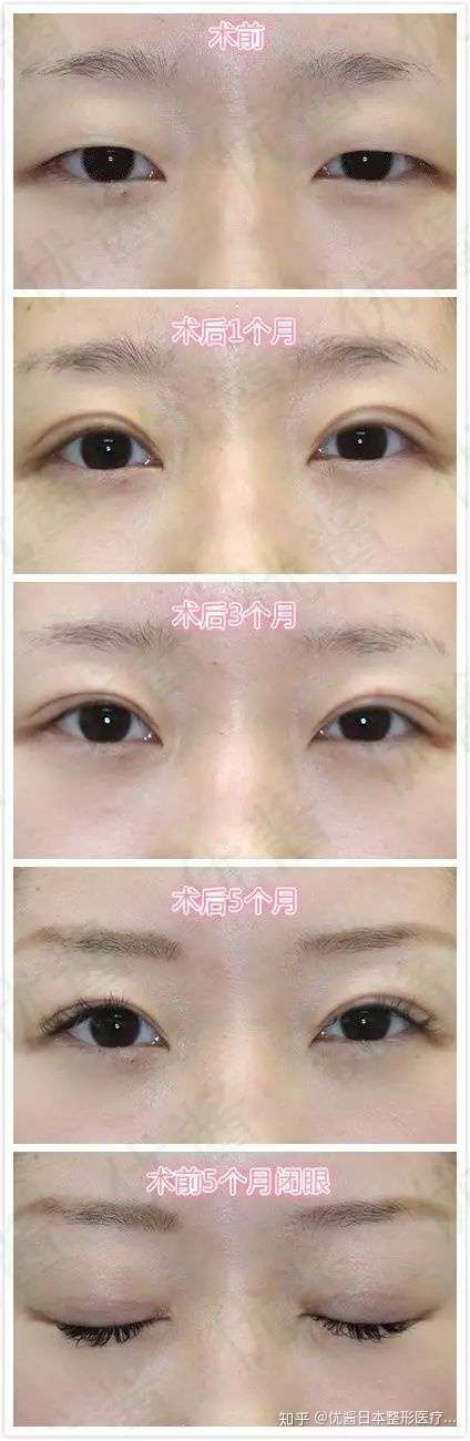 独特的美丽如何打造 何谓 自然 的双眼皮 知乎