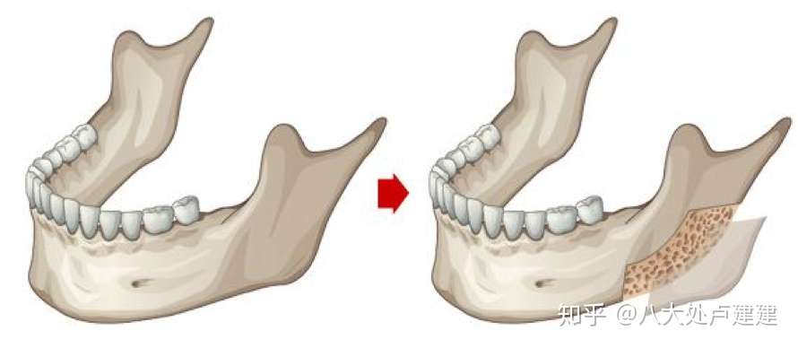正颌手术有哪些种类呢 知乎