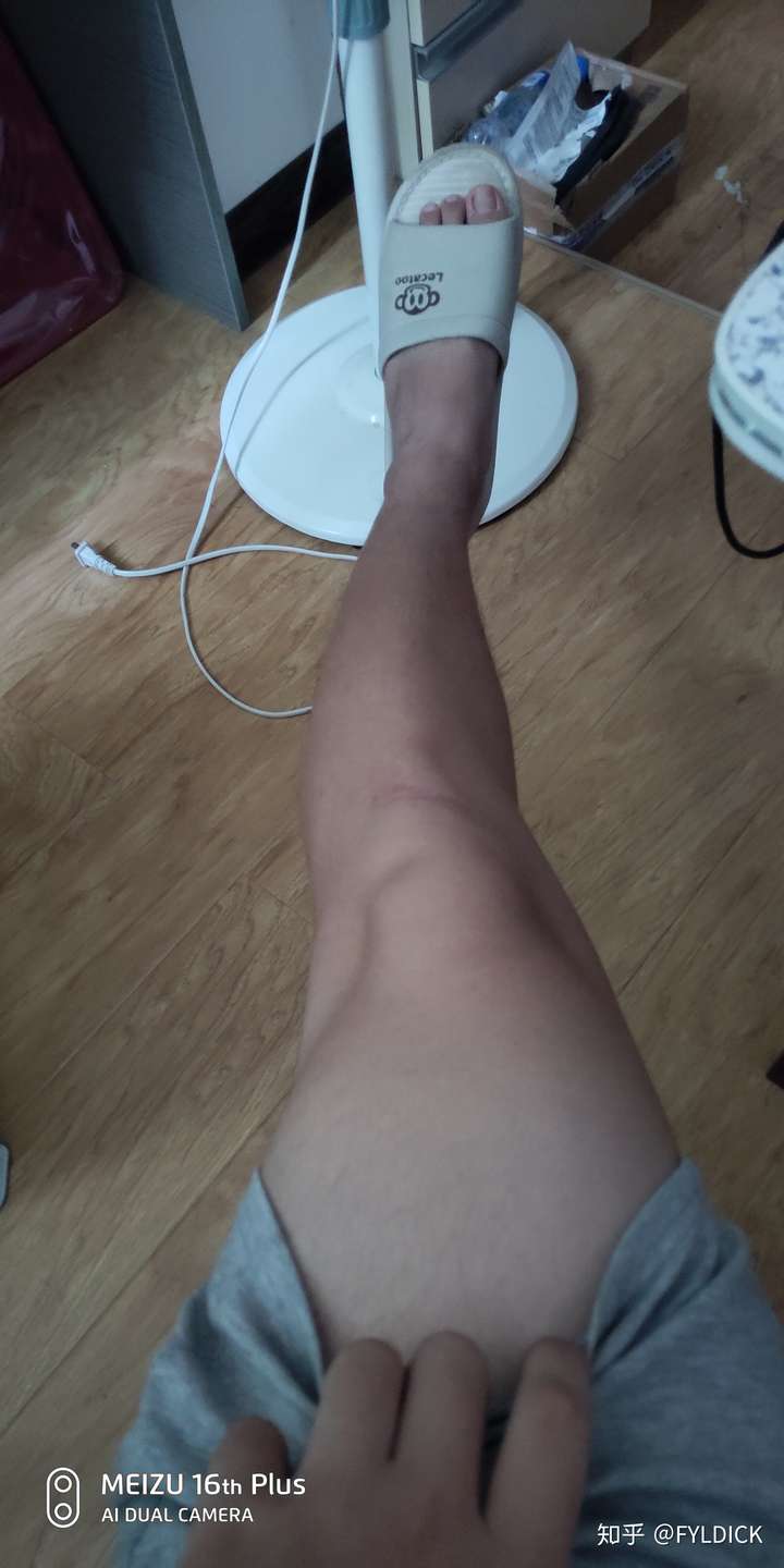 请问我是否患有膝内翻或者膝外翻呢能否治疗呢