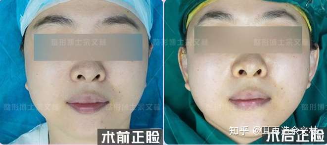 贴发耳矫正后案例 耳朵太贴头皮 照相正面看不到耳朵怎么办 知乎