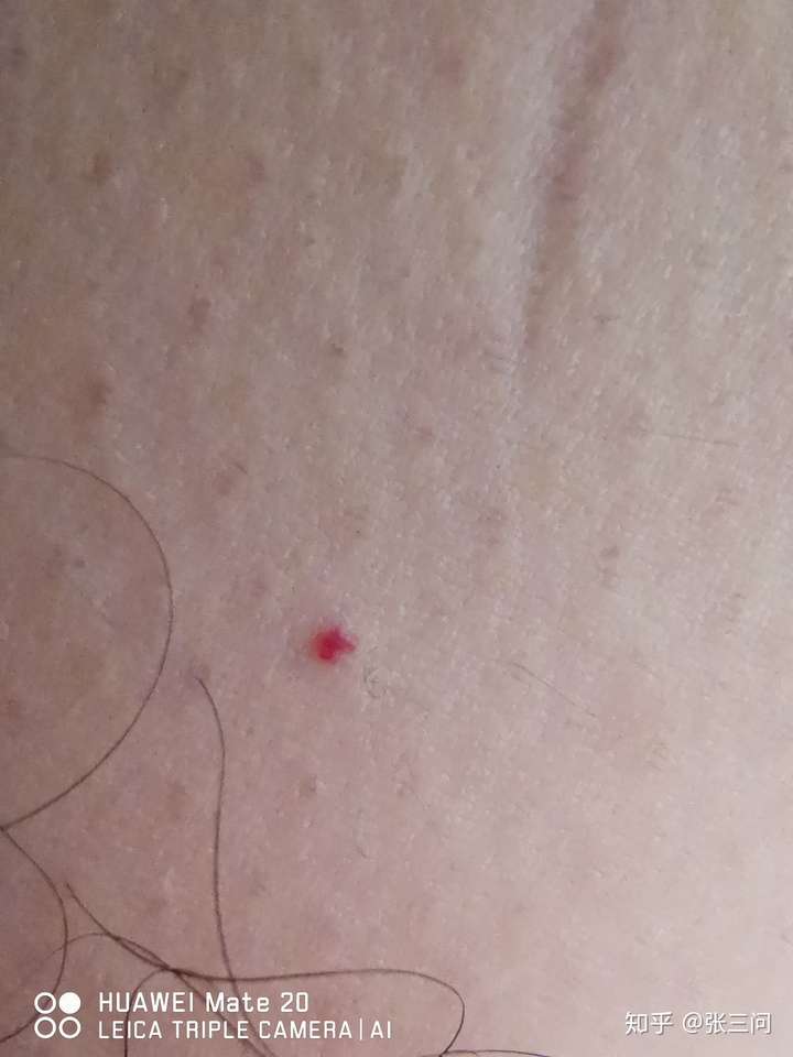 最近身上又长了几个红点,像血点以前只有一个 而且消不下去?