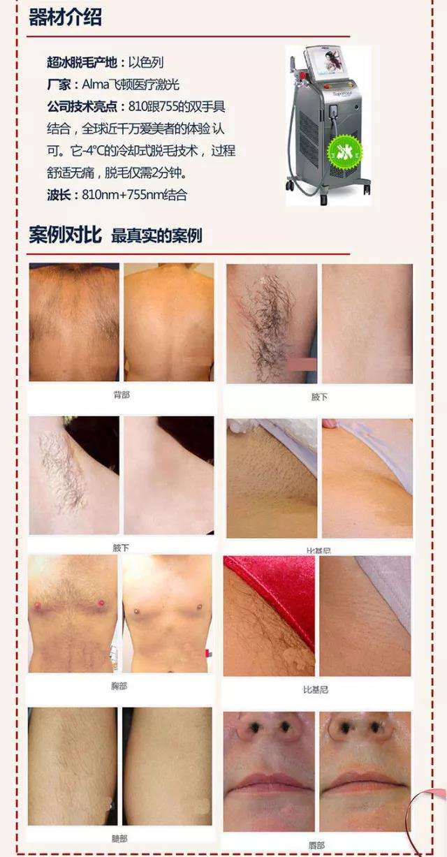 冰点脱毛和激光脱毛有什么区别 哪种脱毛方式更好 知乎