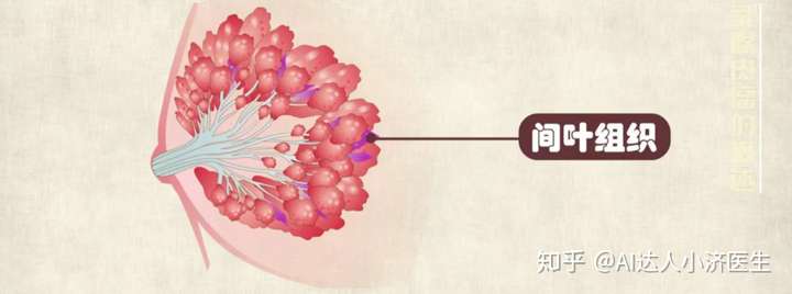 ai達人小濟醫生 乳腺癌的生長部位導管和腺葉 乳腺肉瘤生長部位間葉