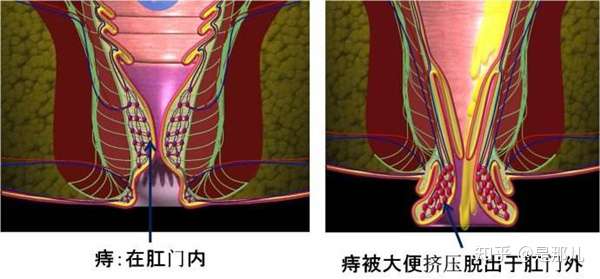 内痔的手术费用是多少 泰斗中医院医师来告诉你真相 知乎