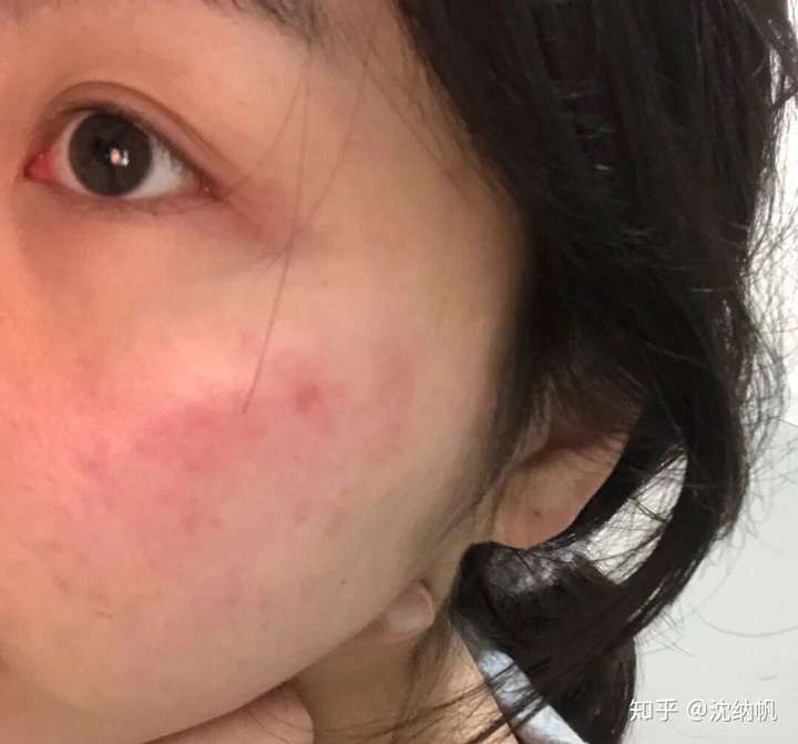 有红血丝就是敏感肌肤吗?