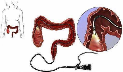 肠镜是检查肛肠疾病的一种筛查方式,随着现代科技的发展,除了传统肠镜