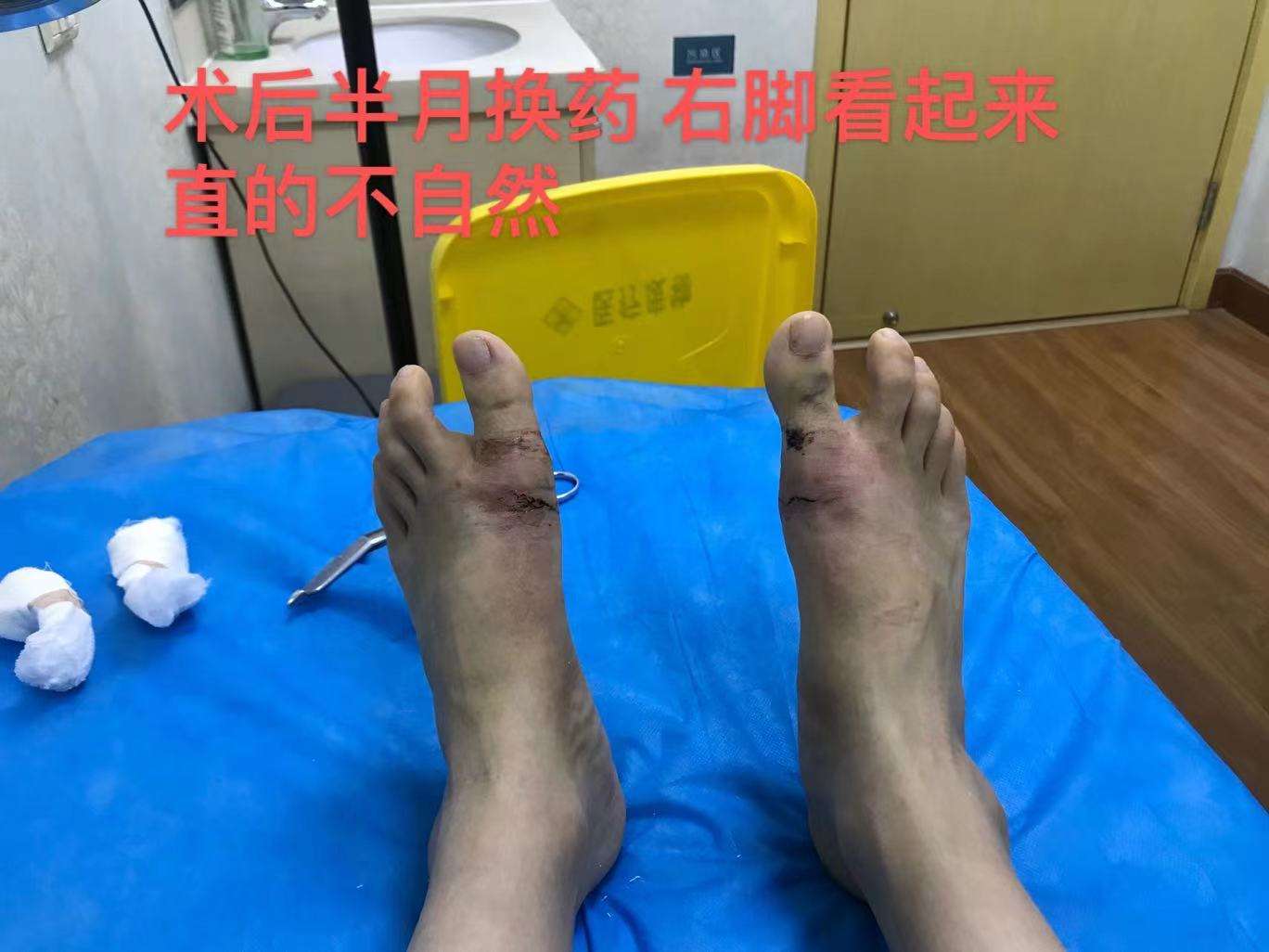 微创拇外翻疼痛的智商税 知乎
