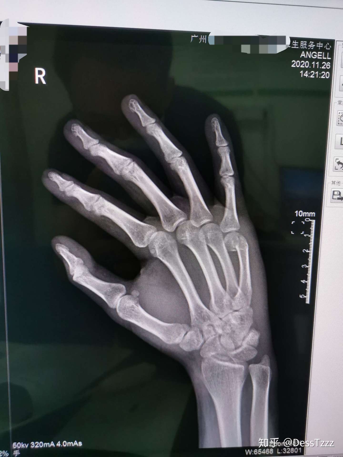 右手第五掌骨折 记录自己的恢复过程 知乎
