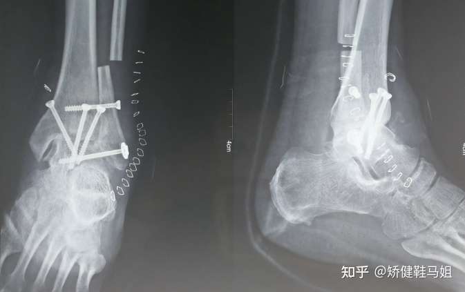 5 29 我爱脚 多知多益呵护爱足 知乎