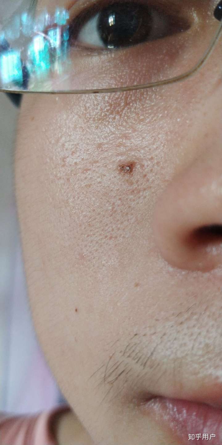 然后就一直这样了,没变化,但是这个不规则,感觉不像一个痣,像好几个痣