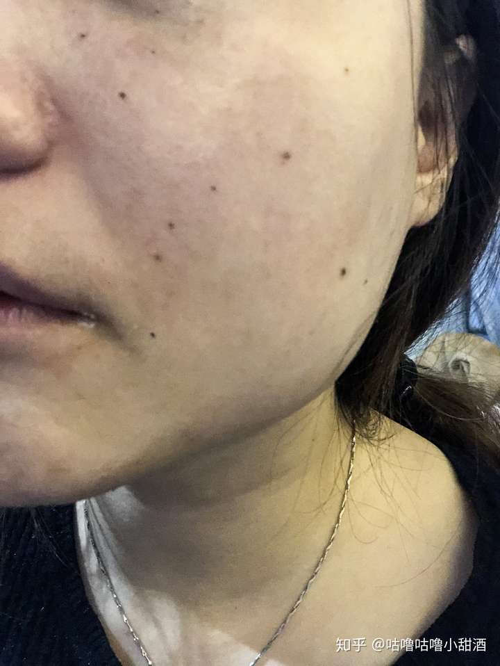 来一张吧 可能是因为点完痣后爱笑了