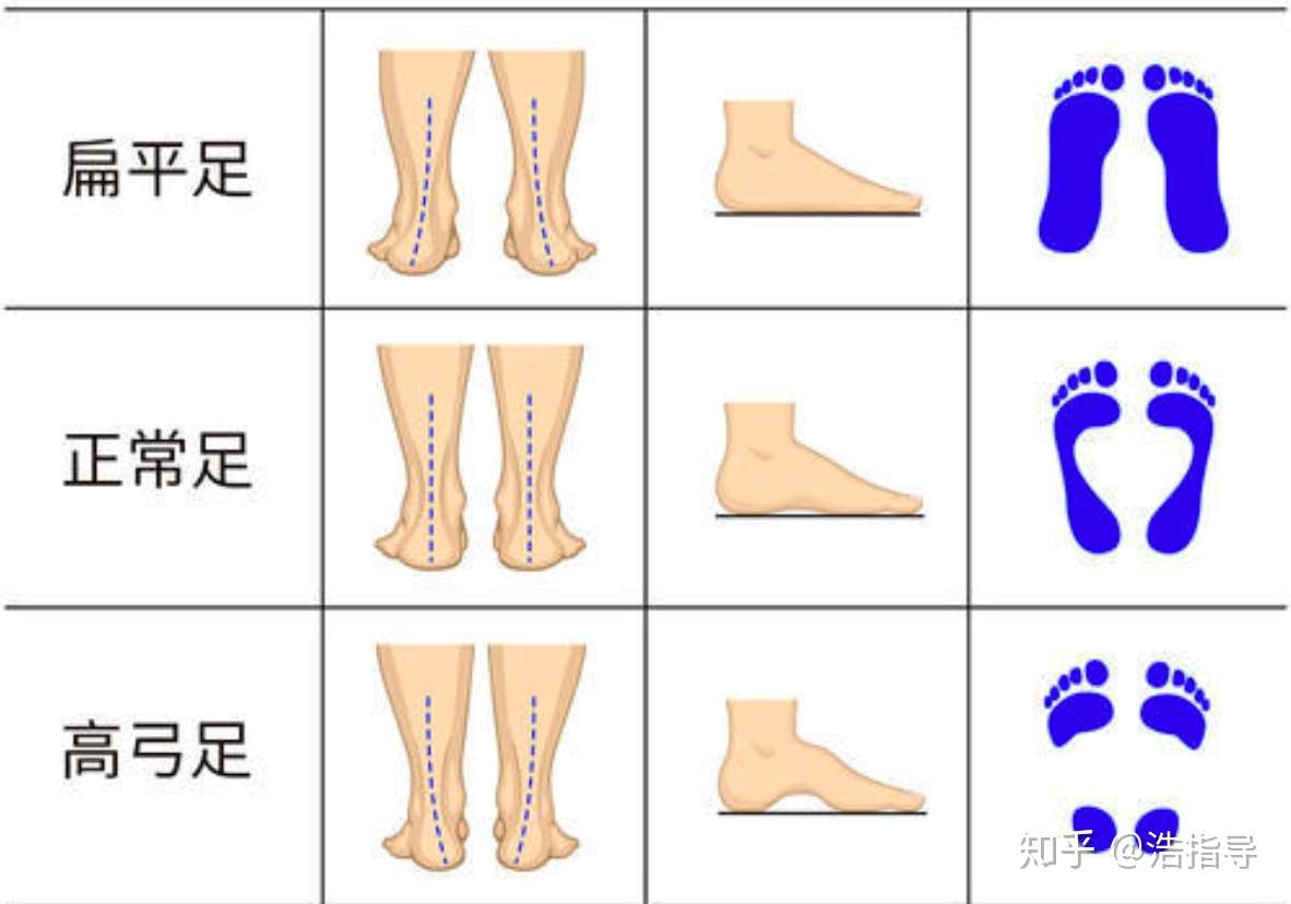 扁平足 足弓塌陷的评估 知乎