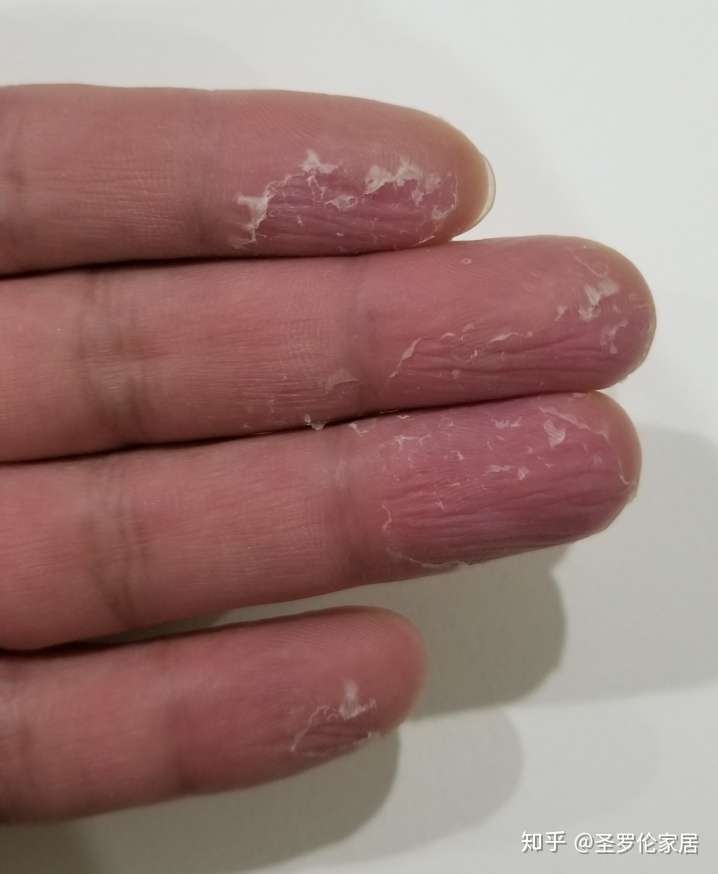 手掌到冬天就掉皮是怎么回事