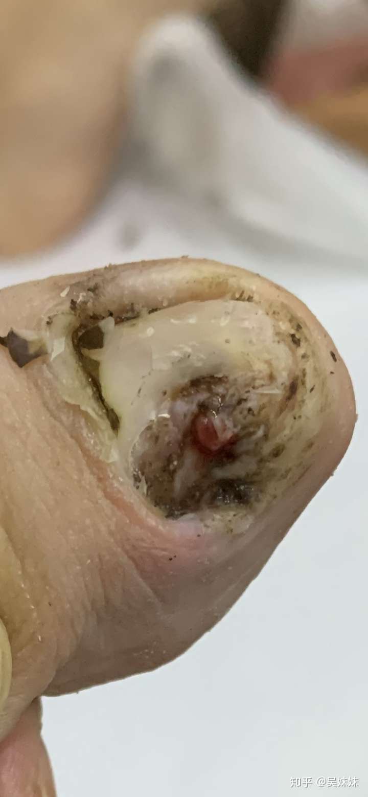 甲下寻常疣做液氮冷冻疼哭了,可耐受疼痛真的这么厉害吗?