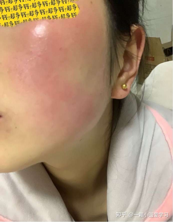 干敏皮,角质层薄,脸泛红,如何修复?
