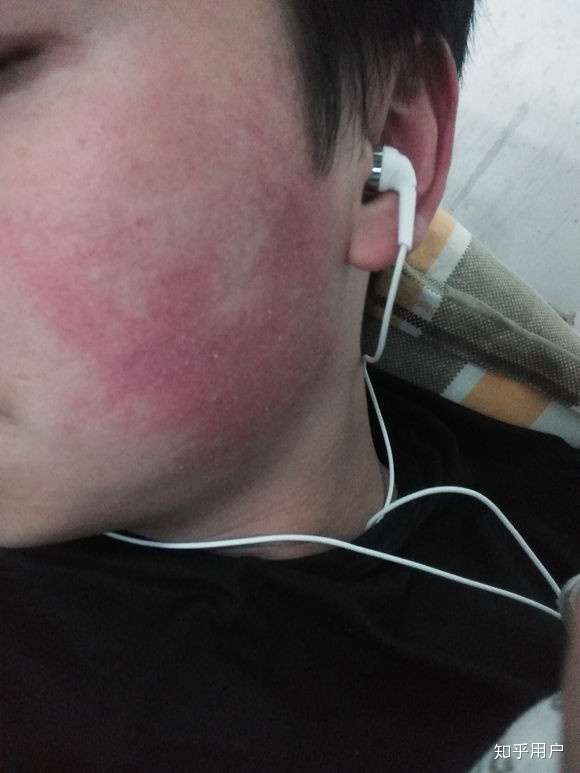 之前自己的脸变得特别红,就是照片上这样.