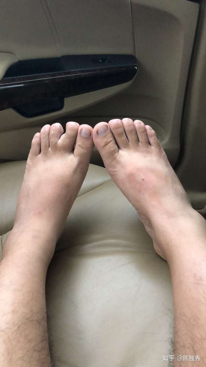 足趾关节滑膜炎,有三个月了,如何快速恢复?