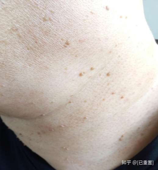 [已重置 很多网友朋友们问我"我这脖子上,腋窝里软软的小肉粒粒是