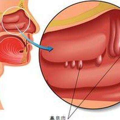 鼻息肉