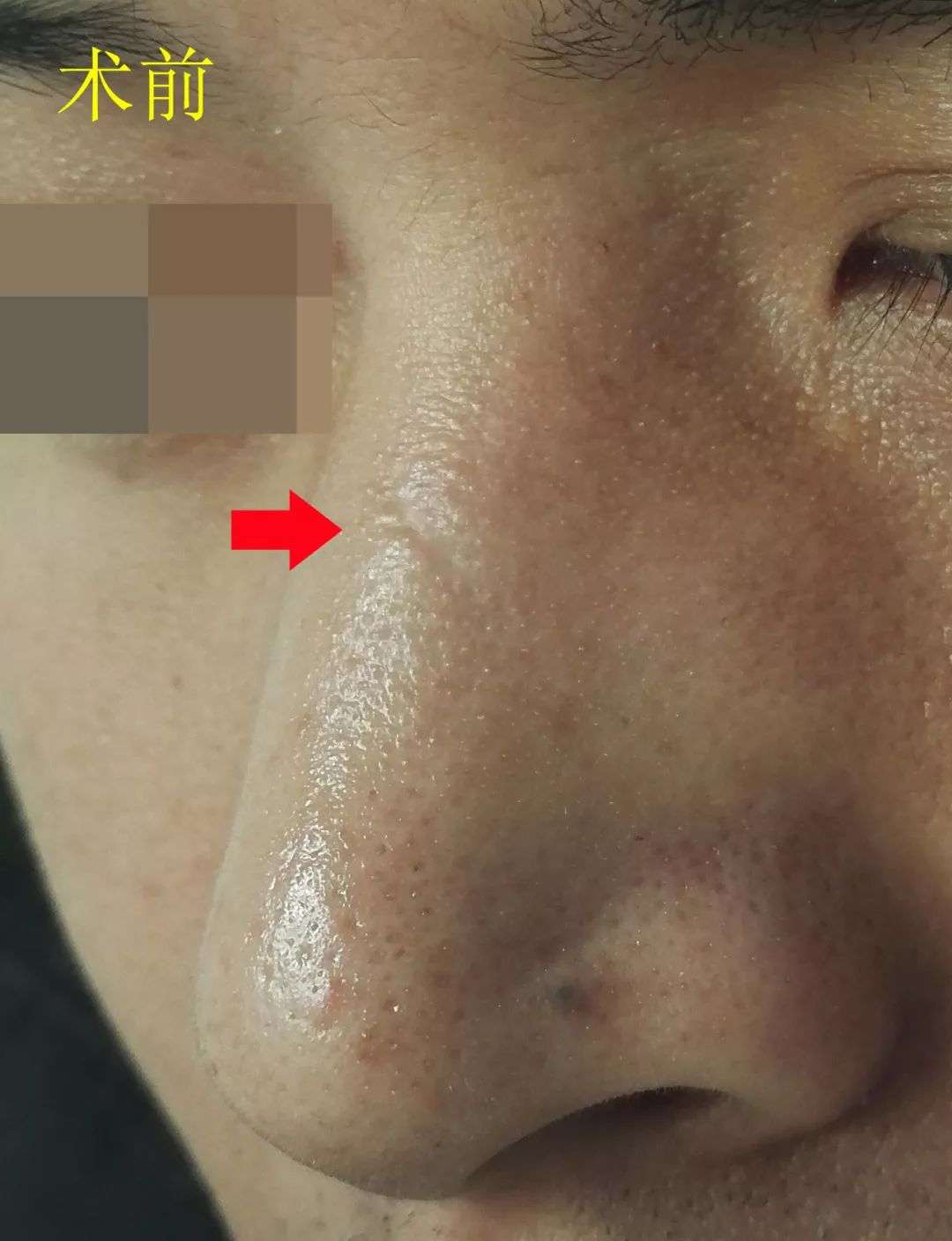 焦虎 的想法: 自体纳米脂肪治疗凹陷性疤痕案例 鼻背部… - 知乎