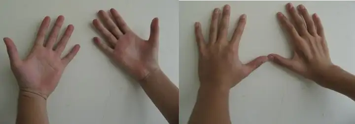 不可忽视的青少年前臂肌肉萎缩