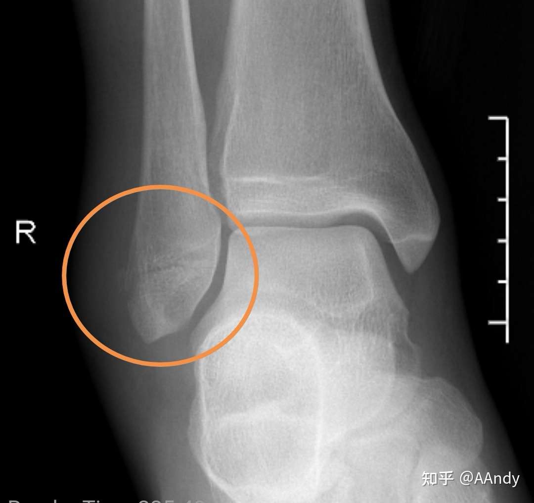 右外踝 腓骨远端 骨折康复记录 知乎