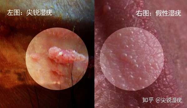 如何区分珍珠疹和疣体图片