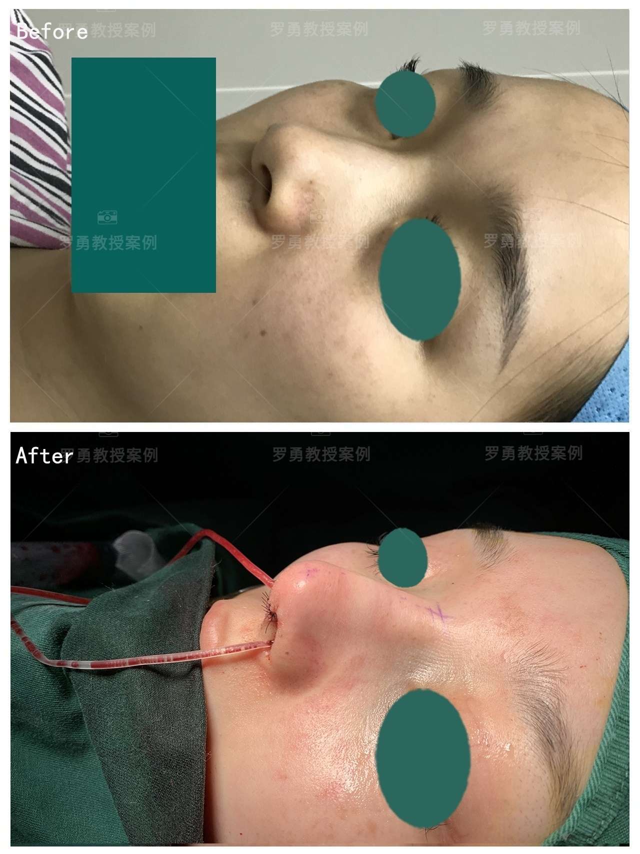 驼峰鼻鼻小柱下垂鼻综合术后即刻