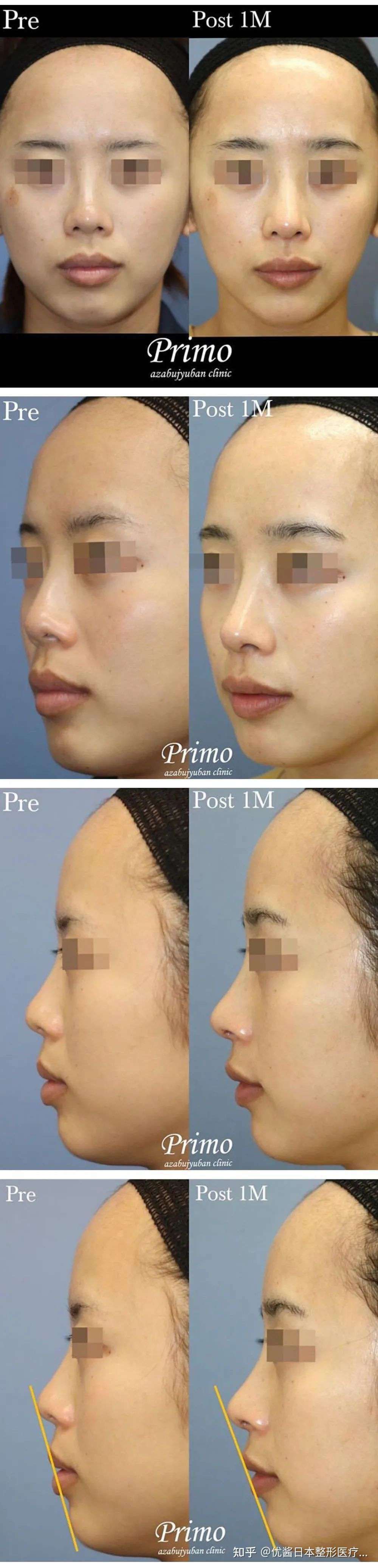 优酱名医图鉴 颜值与实力兼具的眼鼻部整形专家 高野敏郎 知乎