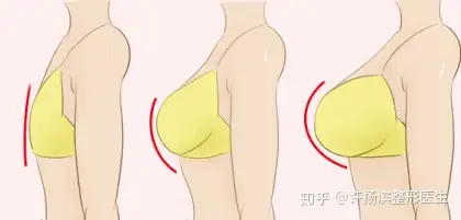 乳房下垂的原因以及如何改善乳房下垂