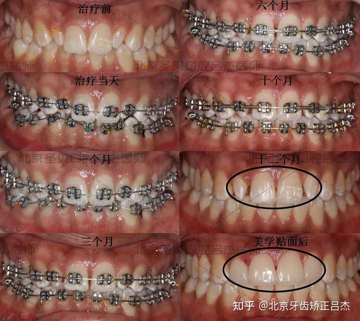 带牙套可以拯救牙齿小吗?