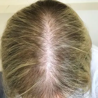 女性型脱发 female pattern hair loss 