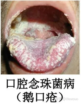 口腔念珠菌病在hiv感染者的口腔损害中最为常见,常表现为红斑型或假膜